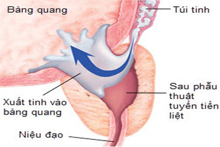 Xuất tinh ngược: Triệu chứng, nguyên nhân và cách phòng ngừa - Ảnh 1. Xuất tinh ngược: Triệu chứng, nguyên nhân và cách phòng ngừa - Ảnh 1.