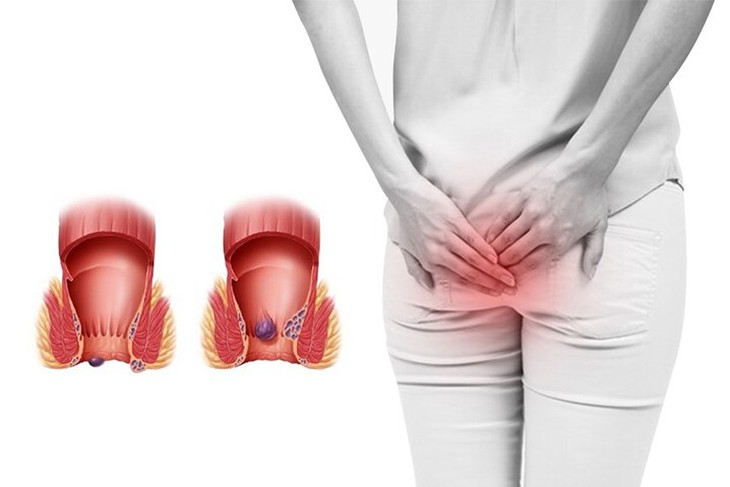 Có 2 loại trĩ được gọi là trĩ nội và trĩ ngoại.
