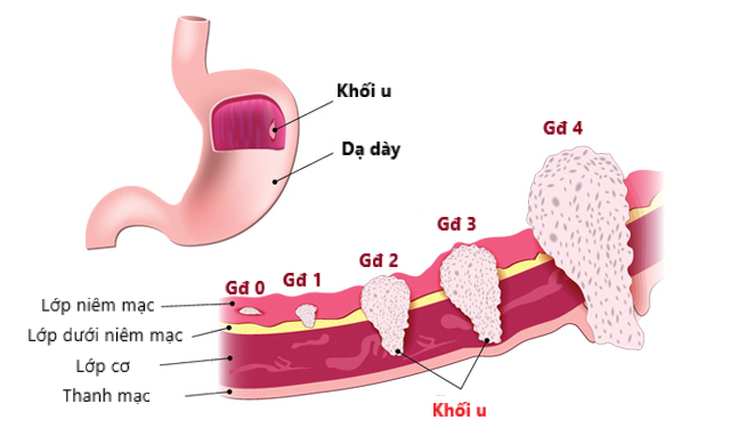 Ung thư dạ dày: Nguyên nhân, biểu hiện và điều trị - Ảnh 2.