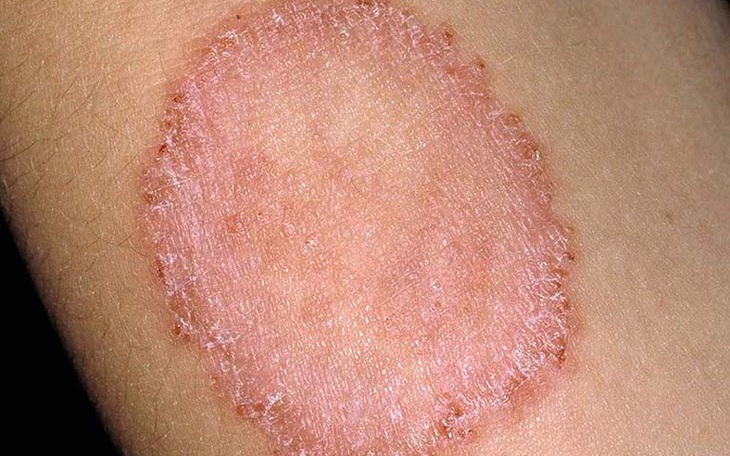 Các loại nấm da và cách phòng ngừa