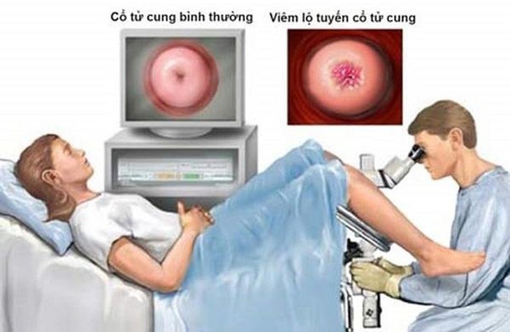 Có nên đốt diệt tuyến khi mắc viêm lộ tuyến cổ tử cung? - Ảnh 1.