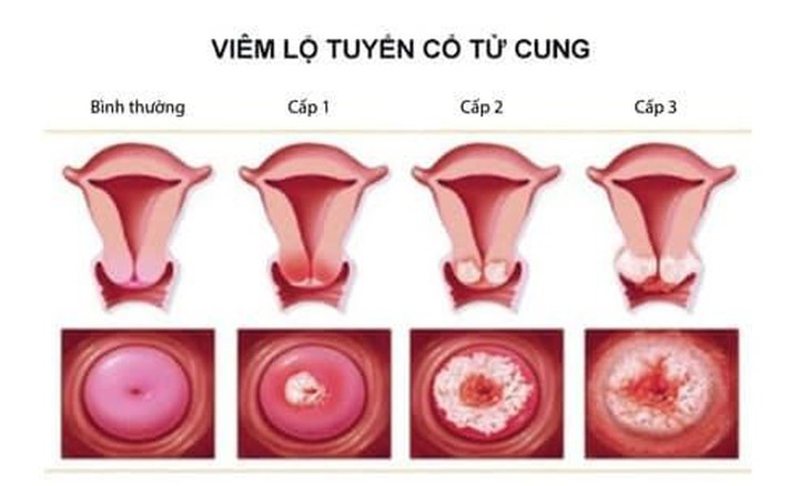 Viêm lộ tuyến cổ tử cung ở phụ nữ hậu quả nghiêm trọng thế nào? - Ảnh 2.