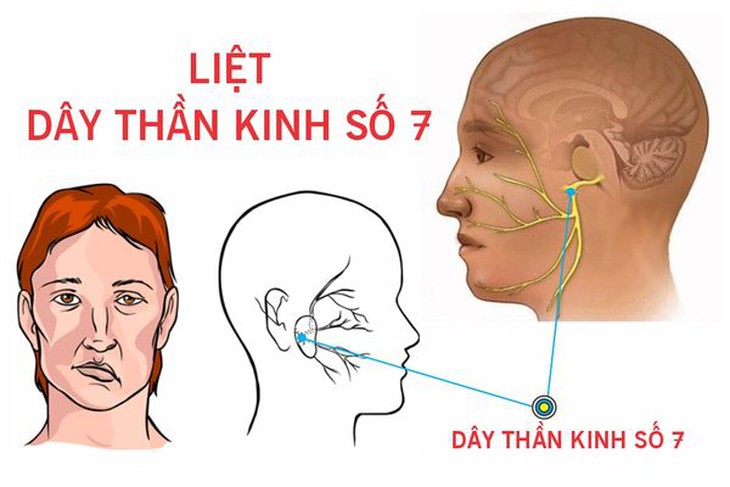 Mắc bệnh ở tai có thể gây liệt mặt và những điều cần lưu ý - Ảnh 3.