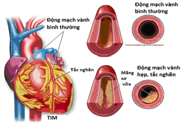 Bệnh động mạch vành và các yếu tố nguy cơ - Ảnh 4. Bệnh động mạch vành và các yếu tố nguy cơ - Ảnh 4.