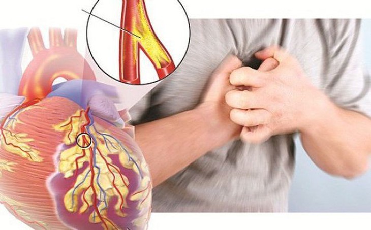 Bệnh động mạch vành và các yếu tố nguy cơ - Ảnh 2. Bệnh động mạch vành và các yếu tố nguy cơ - Ảnh 2.