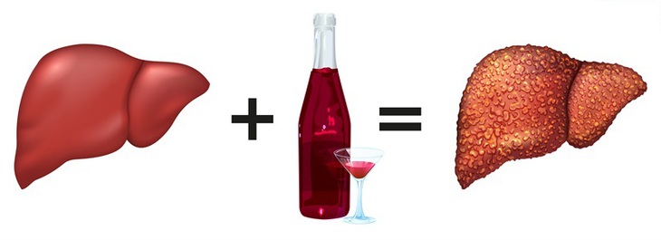 Tổn thương gan do rượu xảy ra khi gan bị hư hỏng do uống rượu. Quá trình phá vỡ ethanol có trong rượu, bia và hóa chất có độc tính cao như acetaldehyde - hóa chất kích hoạt viêm phá hủy tế bào gan.