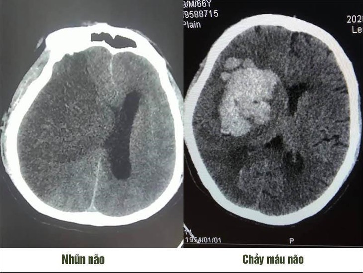 Mùa của đột quỵ não: Làm thế nào để phòng tránh? - Ảnh 1.