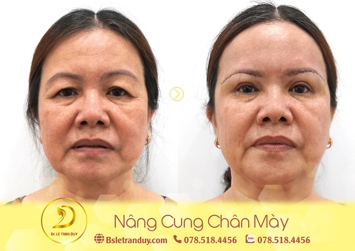 Nâng cung chân mày đẹp, trẻ trung ở bác sĩ giỏi - Ảnh 2.