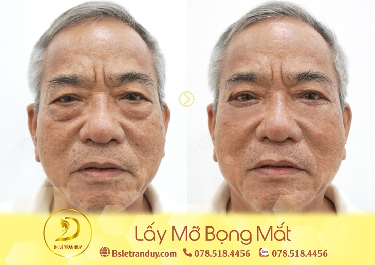 Lấy mỡ bọng mắt đẹp chỉ sau 30 phút - Ảnh 2.