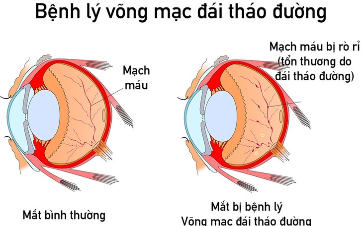 Bệnh võng mạc đái tháo đường - Những điều cần biết