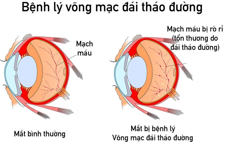 Bệnh võng mạc đái tháo đường- Những điều cần biết - Ảnh 2.