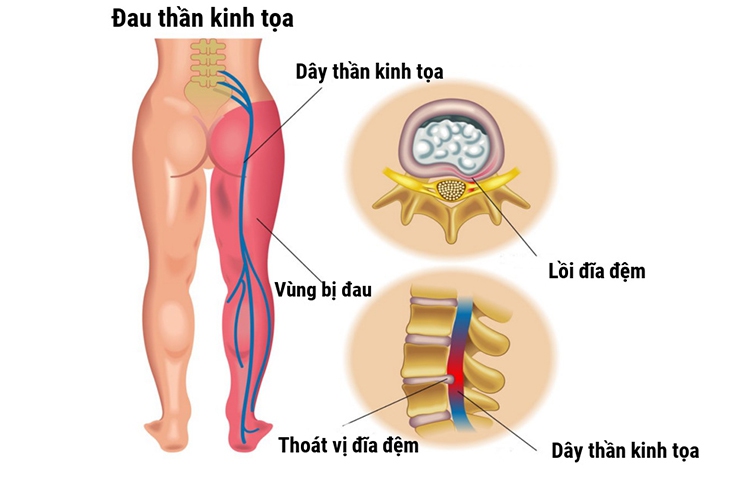 Đau thần kinh tọa có thể điều trị khỏi hoàn toàn không? - Ảnh 1. Đau thần kinh tọa có thể điều trị khỏi hoàn toàn không? - Ảnh 1.