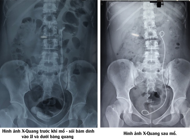 Hy hữu: Một bệnh nhân lãng quên ống Sonde JJ 2 lần trong niệu quản - Ảnh 2. Hy hữu: Một bệnh nhân lãng quên ống Sonde JJ 2 lần trong niệu quản - Ảnh 2.