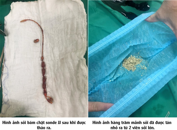 Hy hữu: Một bệnh nhân lãng quên ống Sonde JJ 2 lần trong niệu quản - Ảnh 1. Hy hữu: Một bệnh nhân lãng quên ống Sonde JJ 2 lần trong niệu quản - Ảnh 1.
