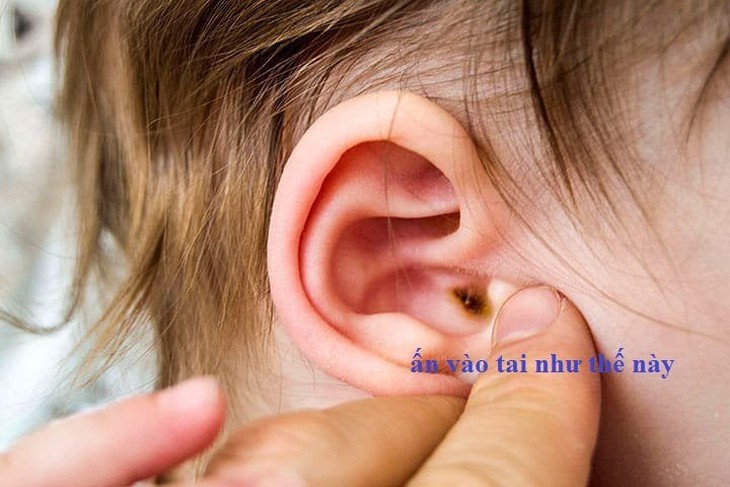Nhọt ống tai ở trẻ nhỏ - Ảnh 3.