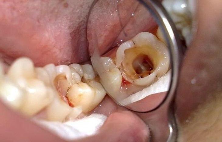 Sâu răng ở trẻ em: Nhận biết, nguyên nhân và điều trị - Ảnh 3. Sâu răng ở trẻ em: Nhận biết, nguyên nhân và điều trị - Ảnh 3.