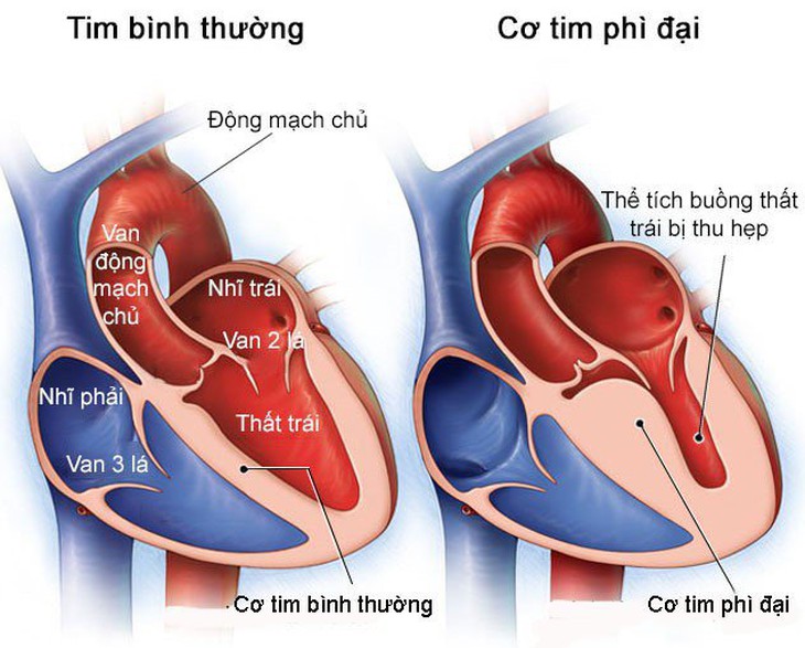 Bệnh cơ tim: Nguyên nhân, triệu chứng và cách điều trị - Ảnh 1. Bệnh cơ tim: Nguyên nhân, triệu chứng và cách điều trị - Ảnh 1.