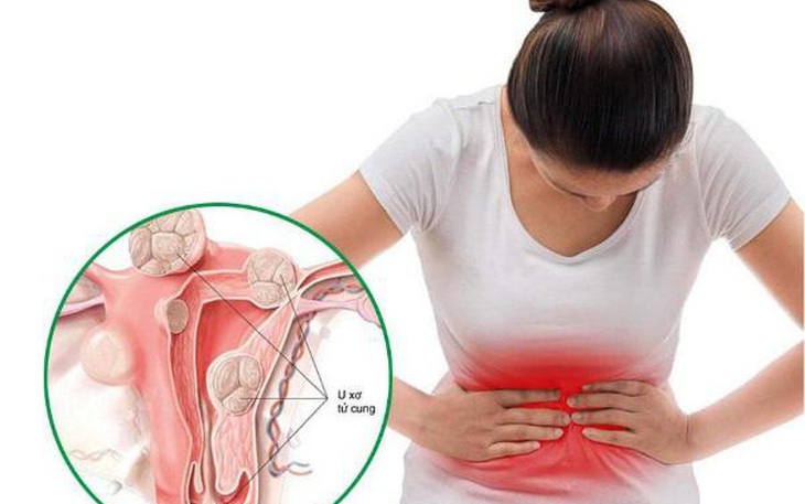 U xơ tử cung có nguy hiểm không? Triệu chứng và cách điều trị hiện nay