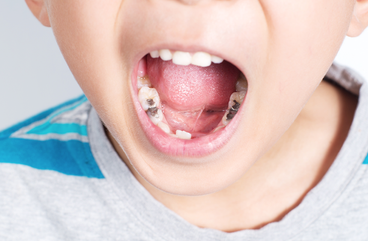 Sâu răng ở trẻ em: Nhận biết, nguyên nhân và điều trị - Ảnh 5. Sâu răng ở trẻ em: Nhận biết, nguyên nhân và điều trị - Ảnh 5.