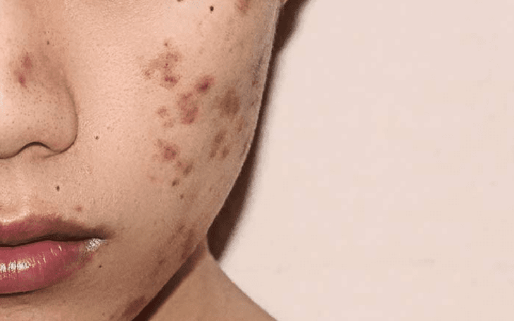 Mụn thâm nguyên nhân do đâu? Làm thế nào để xử lý?