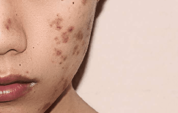 Mụn thâm nguyên nhân do đâu? Làm thế nào để xử lý? - Ảnh 1.