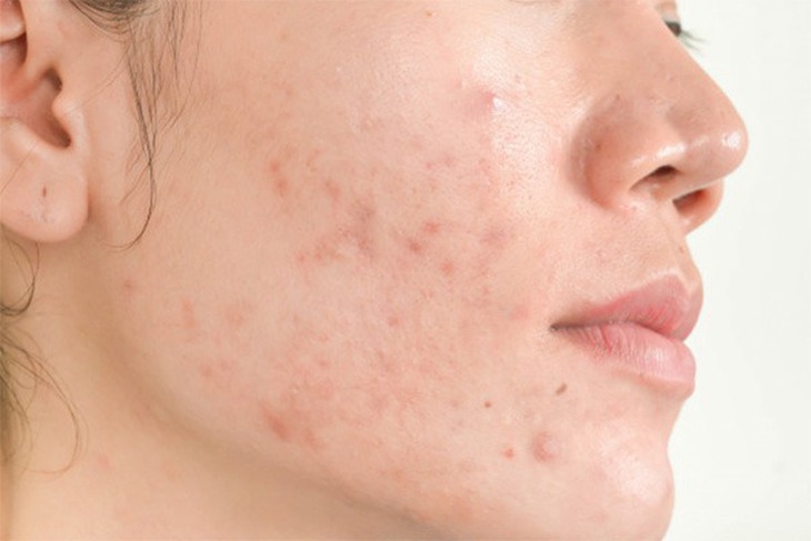 Dị ứng mỹ phẩm là phản ứng khác thường của da khi tiếp xúc với loại mỹ phẩm mà thành phần có chất gây dị ứng (dị nguyên).