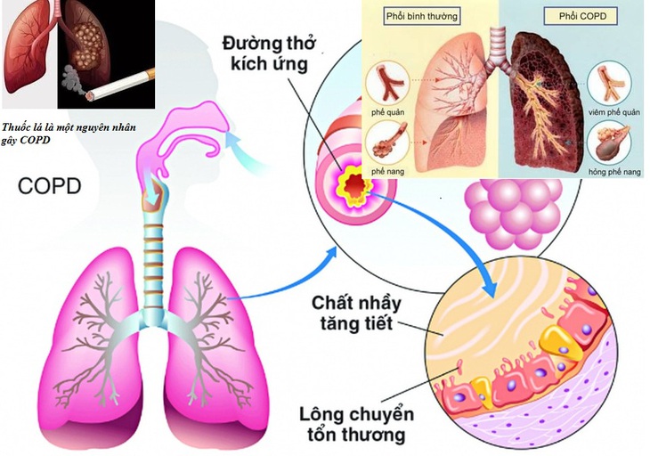 Điều trị COPD thế nào dự phòng đợt cấp trong mùa lạnh? - Ảnh 1.