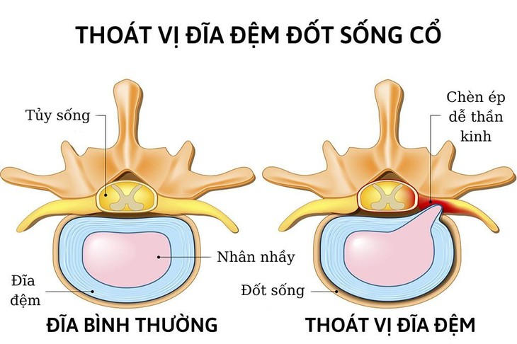 Ai cần phẫu thuật thay đĩa đệm nhân tạo cột sống cổ - Ảnh 2.