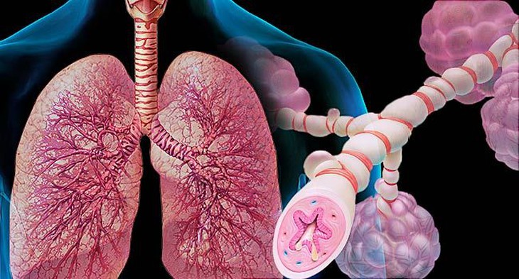 Thuốc nào điều trị hen phế quản? - Ảnh 1. Thuốc nào điều trị hen phế quản? - Ảnh 1.