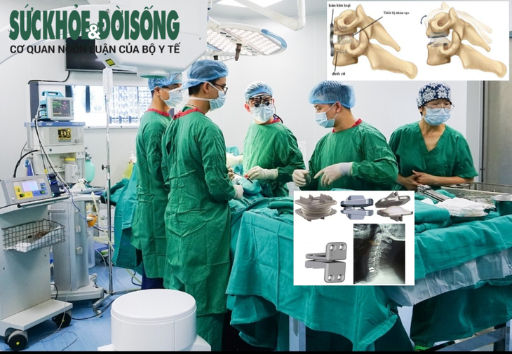 Lựa chọn thay đĩa đệm nhân tạo cột sống cổ hay cắt đĩa đệm và hàn lối trước? - Ảnh 1.