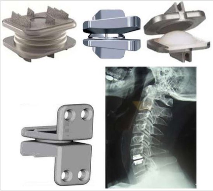Lựa chọn thay đĩa đệm nhân tạo cột sống cổ hay cắt đĩa đệm và hàn lối trước? - Ảnh 3.