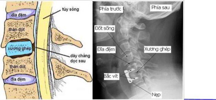 Lựa chọn thay đĩa đệm nhân tạo cột sống cổ hay cắt đĩa đệm và hàn lối trước? - Ảnh 5.