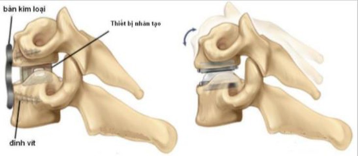 Lựa chọn thay đĩa đệm nhân tạo cột sống cổ hay cắt đĩa đệm và hàn lối trước? - Ảnh 6.