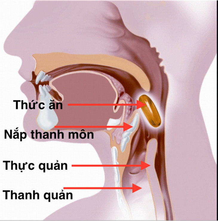 Rối loạn nuốt và vai trò của chất làm đặc - Ảnh 1.
