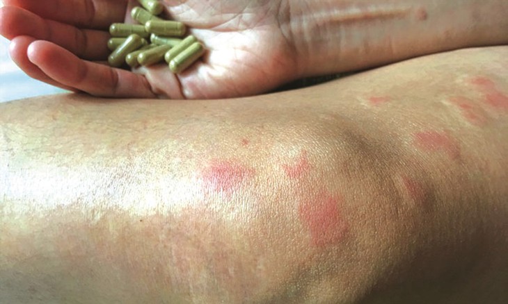 Thuốc trị sốt rét có tác dụng tốt đối với bệnh lupus ban đỏ - Ảnh 2.
