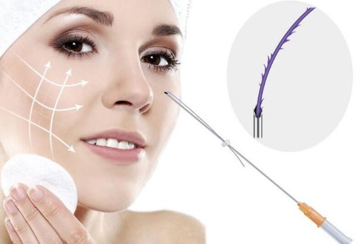 Nâng mũi bằng chỉ hiệu quả như thế nào? - Ảnh 2.