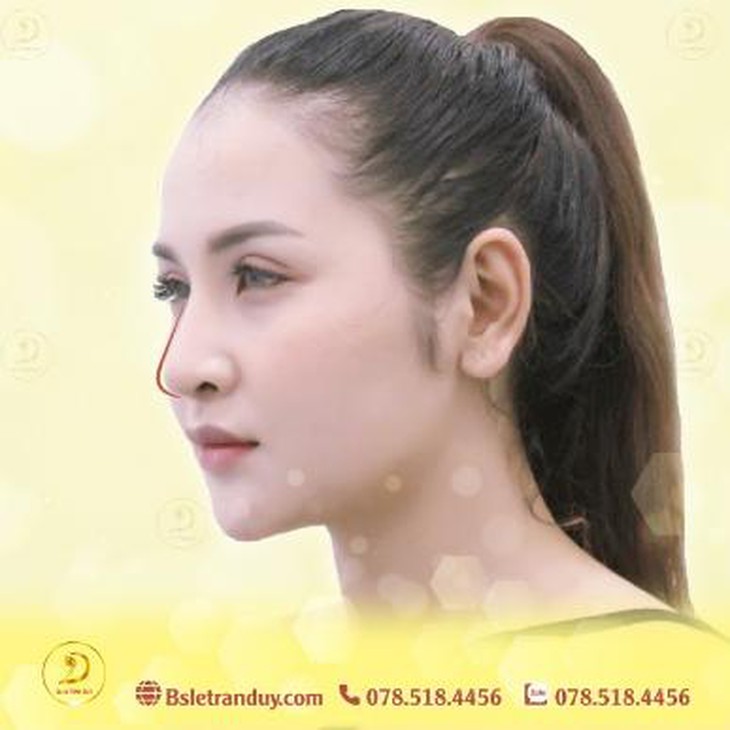 Mũi tẹt – Phương pháp nào để làm mũi đẹp? - Ảnh 2. mui tet