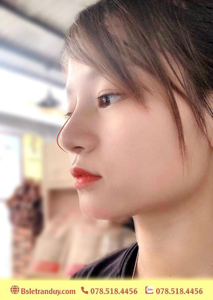 Mũi tẹt – Phương pháp nào để làm mũi đẹp? - Ảnh 3. mui tet
