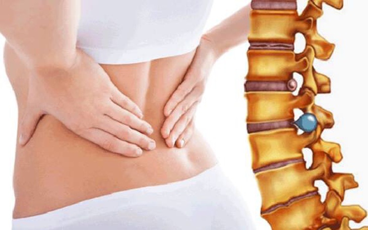 Viêm cột sống dính khớp: Triệu chứng, nguyên nhân và cách điều trị