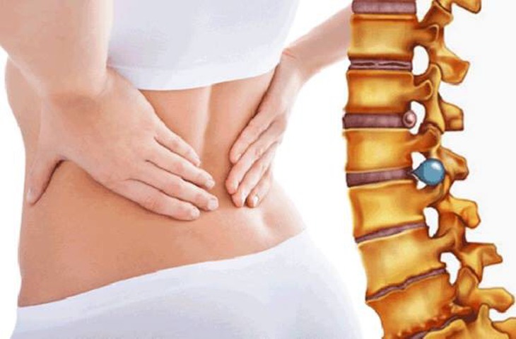 Viêm cột sống dính khớp: Triệu chứng, nguyên nhân và cách điều trị - Ảnh 3.