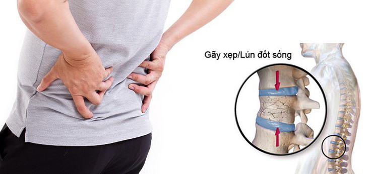 Viêm cột sống dính khớp: Triệu chứng, nguyên nhân và cách điều trị - Ảnh 5.