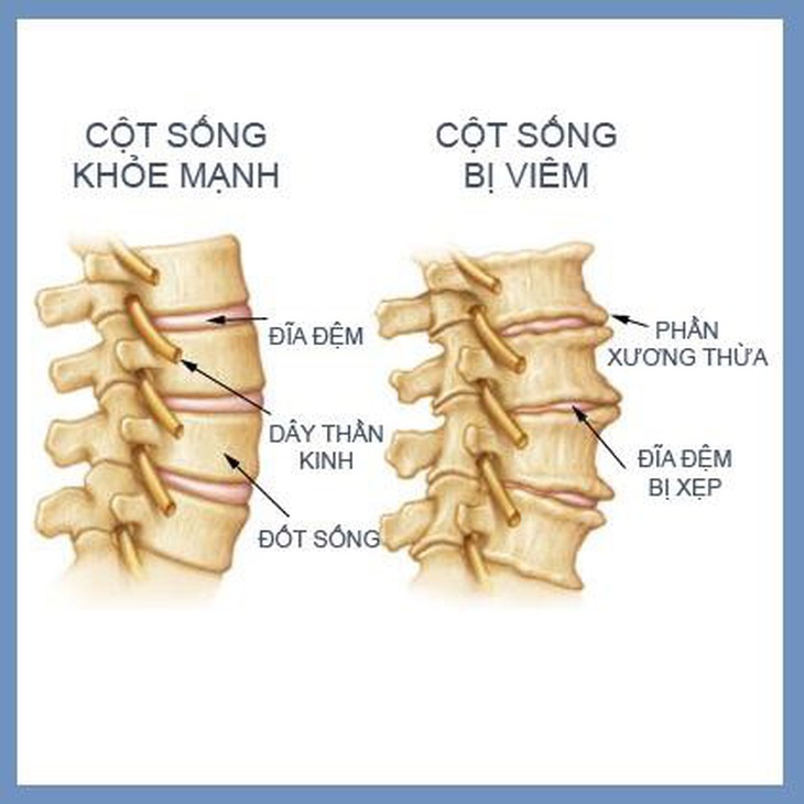 Viêm cột sống dính khớp: Triệu chứng, nguyên nhân và cách điều trị - Ảnh 2.