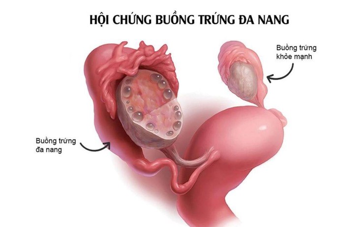 Các lý do có thể gây vô sinh thứ phát - Ảnh 2.