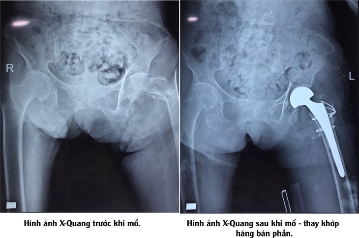 Phẫu thuật thành công cho cụ bà 96 tuổi gãy liên mấu chuyển xương đùi phức tạp - Ảnh 2.