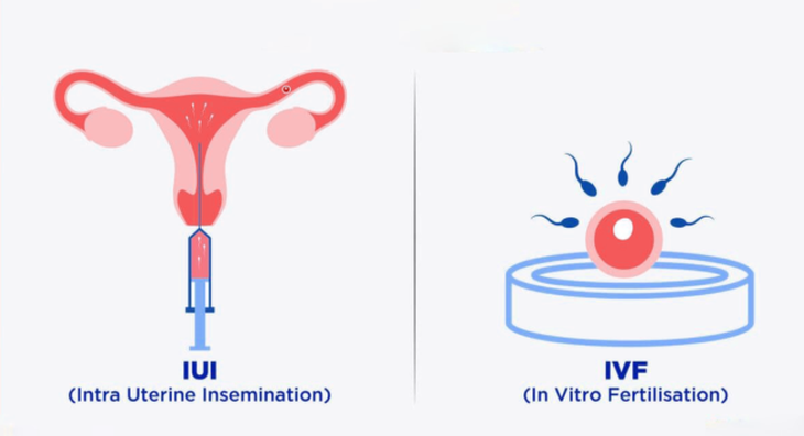 Các lý do có thể gây vô sinh thứ phát - Ảnh 4.