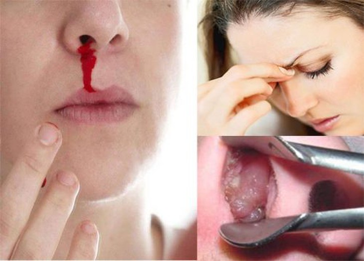 Các loại u lành tính mũi xoang thường gặp: Nhận biết, nguyên nhân và điều trị - Ảnh 4.