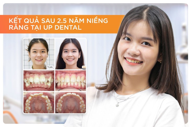 9x chia sẻ trải nghiệm niềng răng kiến tạo nụ cười - Ảnh 2.