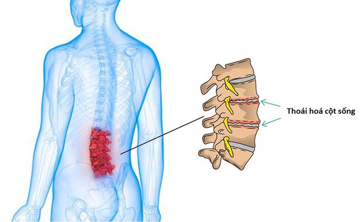 Thoái hóa cột sống thắt lưng: Nguyên nhân, triệu chứng và cách điều trị hiệu quả ai cũng cần phải biết - Ảnh 1.