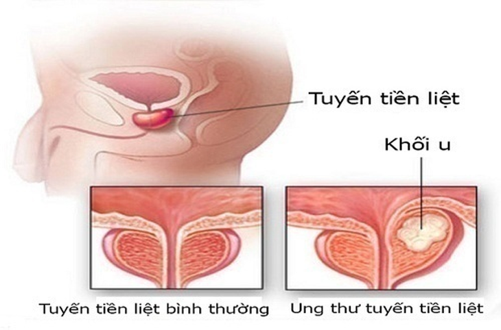 Nguyên nhân nào gây ra rò rỉ tinh dịch và cách điều trị - Ảnh 3.