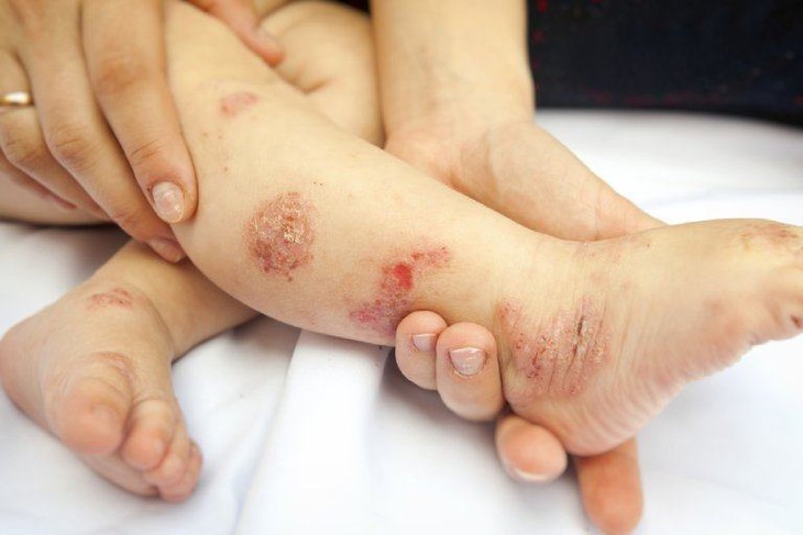 Trẻ bị viêm da cơ địa cần chăm sóc đúng khi thời tiết chuyển mùa - Ảnh 1.